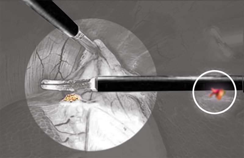 Intra-Operative-Insulation-Failure-Patient-Burn-Unshielded-Monopolar-Instrument